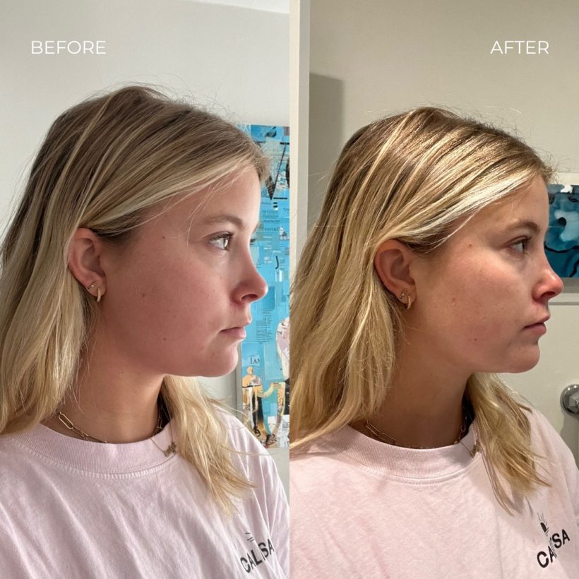 depuffing chin strap