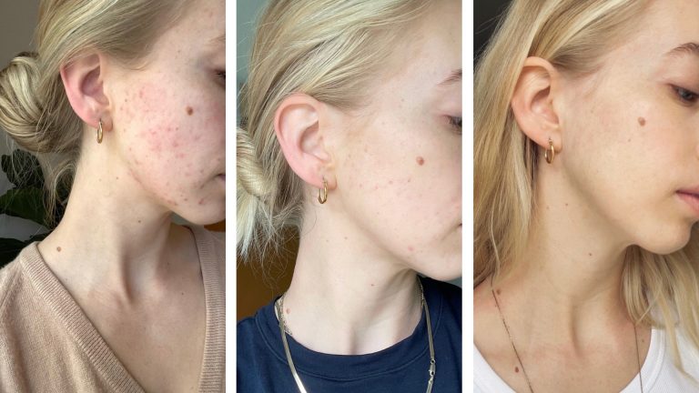 Before and after hormonal acne skincare tips.