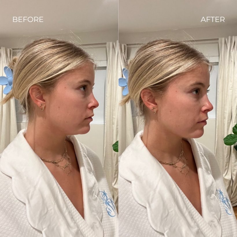 depuffing chin strap