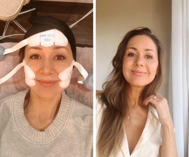 I Tried Emface, a Needle-Free Alternative to Fillers